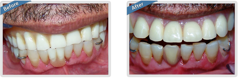 hypodontia before and after